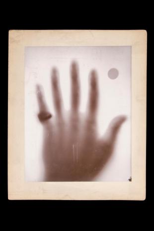 x-ray of hand with ring