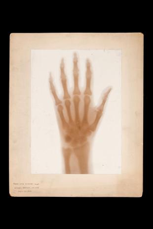 x-ray of hand with embedded scissors point