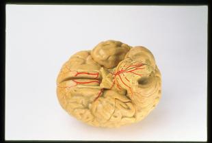 Luys-type clastic model of the human brain