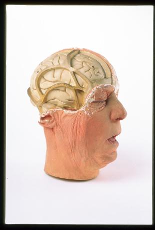 Model of the head of an older man, brain exposed on the right-hand side